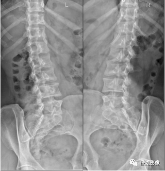 影像PPT - 狗戴项圈征-1 影像PPT - 狗戴项圈征-1