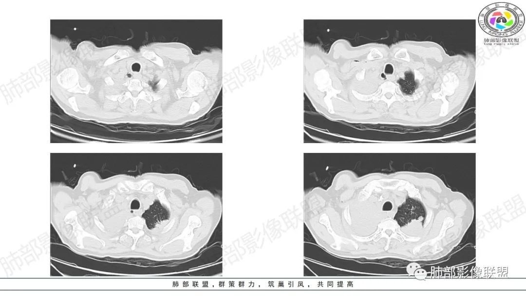 影像PPT - 【病例】来势汹汹肺包块—不典型类癌-5 影像PPT - 【病例】来势汹汹肺包块—不典型类癌-5