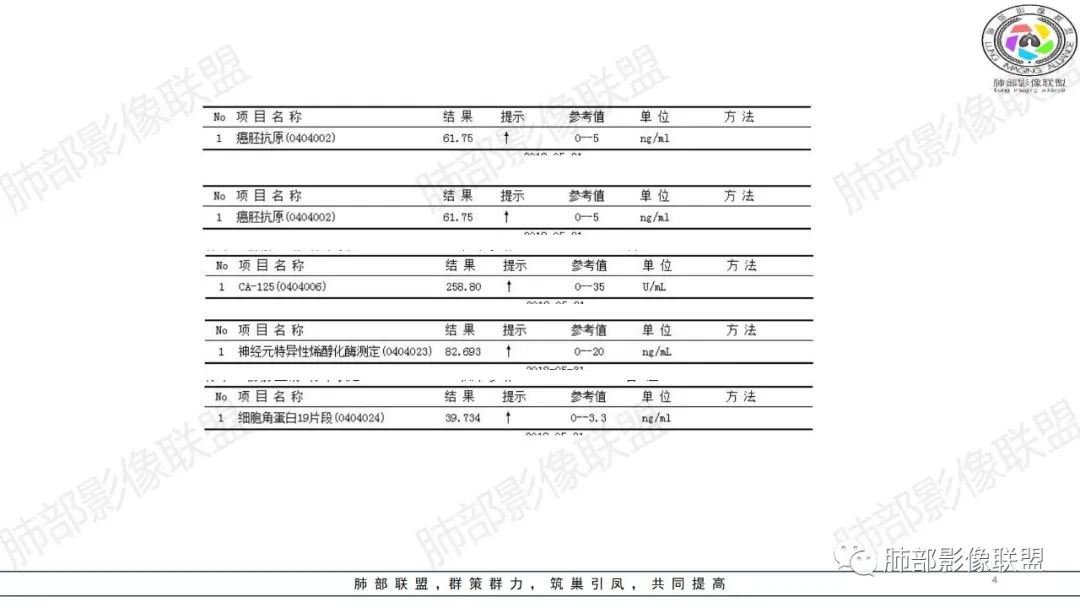影像PPT - 【病例】来势汹汹肺包块—不典型类癌-4 影像PPT - 【病例】来势汹汹肺包块—不典型类癌-4
