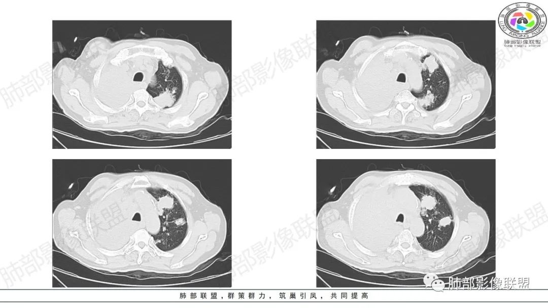 影像PPT - 【病例】来势汹汹肺包块—不典型类癌-6 影像PPT - 【病例】来势汹汹肺包块—不典型类癌-6