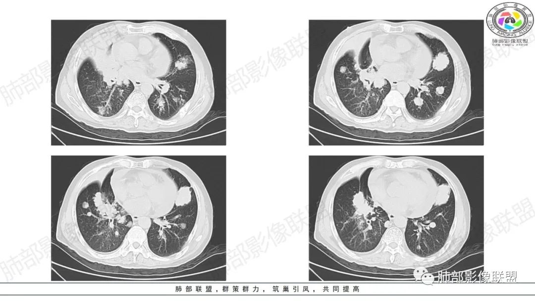 影像PPT - 【病例】来势汹汹肺包块—不典型类癌-7 影像PPT - 【病例】来势汹汹肺包块—不典型类癌-7
