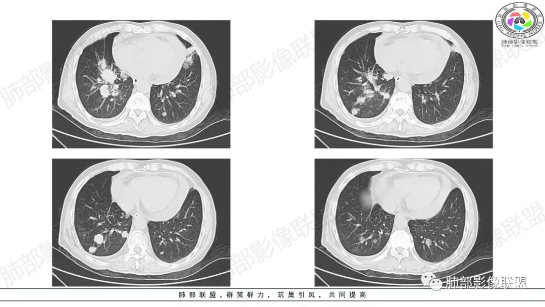 影像PPT - 【病例】来势汹汹肺包块—不典型类癌-8 影像PPT - 【病例】来势汹汹肺包块—不典型类癌-8