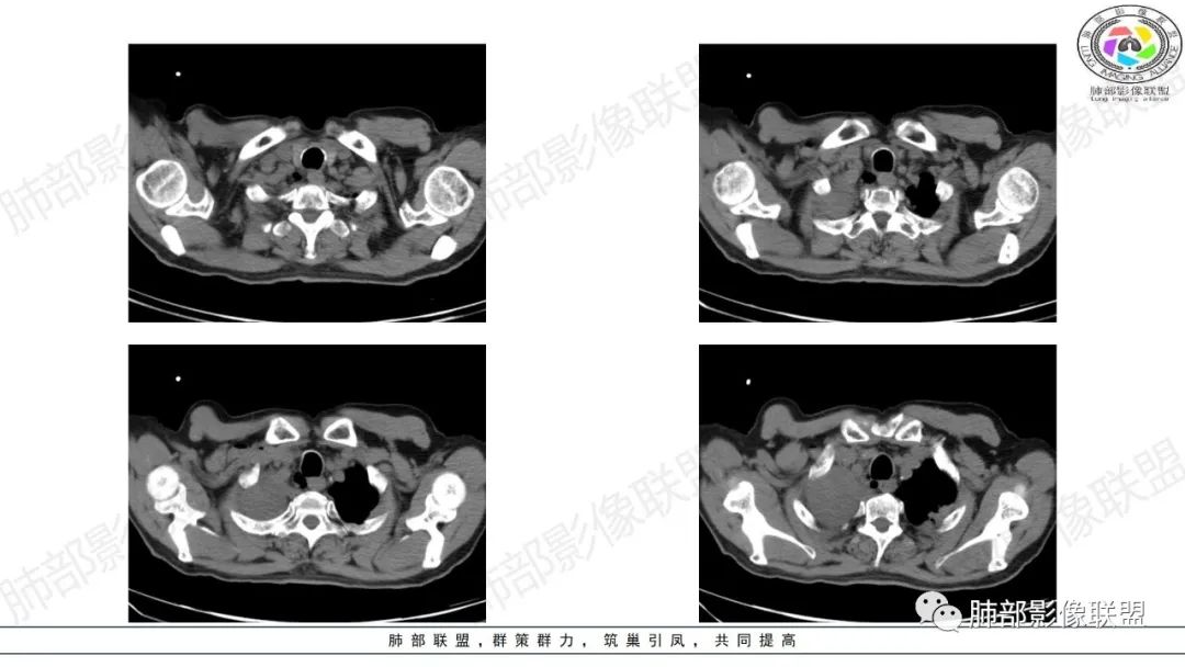 影像PPT - 【病例】来势汹汹肺包块—不典型类癌-10 影像PPT - 【病例】来势汹汹肺包块—不典型类癌-10
