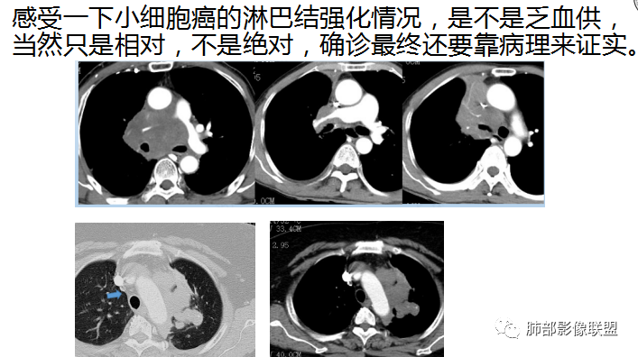 影像PPT - 【病例】来势汹汹肺包块—不典型类癌-38 影像PPT - 【病例】来势汹汹肺包块—不典型类癌-38