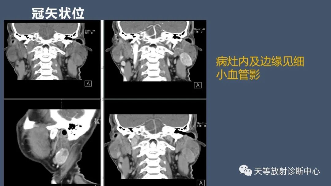 影像PPT - 【病例】腮腺腺淋巴瘤2例CT及MRI表现-2 影像PPT - 【病例】腮腺腺淋巴瘤2例CT及MRI表现-2