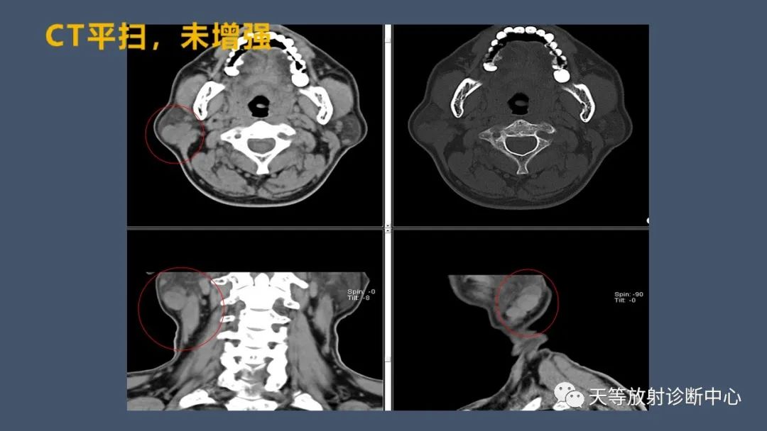 影像PPT - 【病例】腮腺腺淋巴瘤2例CT及MRI表现-3 影像PPT - 【病例】腮腺腺淋巴瘤2例CT及MRI表现-3