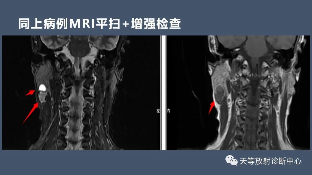 影像PPT - 【病例】腮腺腺淋巴瘤2例CT及MRI表现-4 影像PPT - 【病例】腮腺腺淋巴瘤2例CT及MRI表现-4