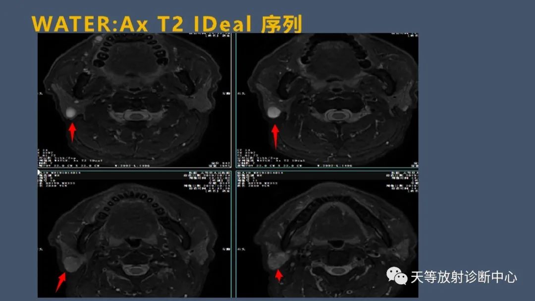 影像PPT - 【病例】腮腺腺淋巴瘤2例CT及MRI表现-5 影像PPT - 【病例】腮腺腺淋巴瘤2例CT及MRI表现-5