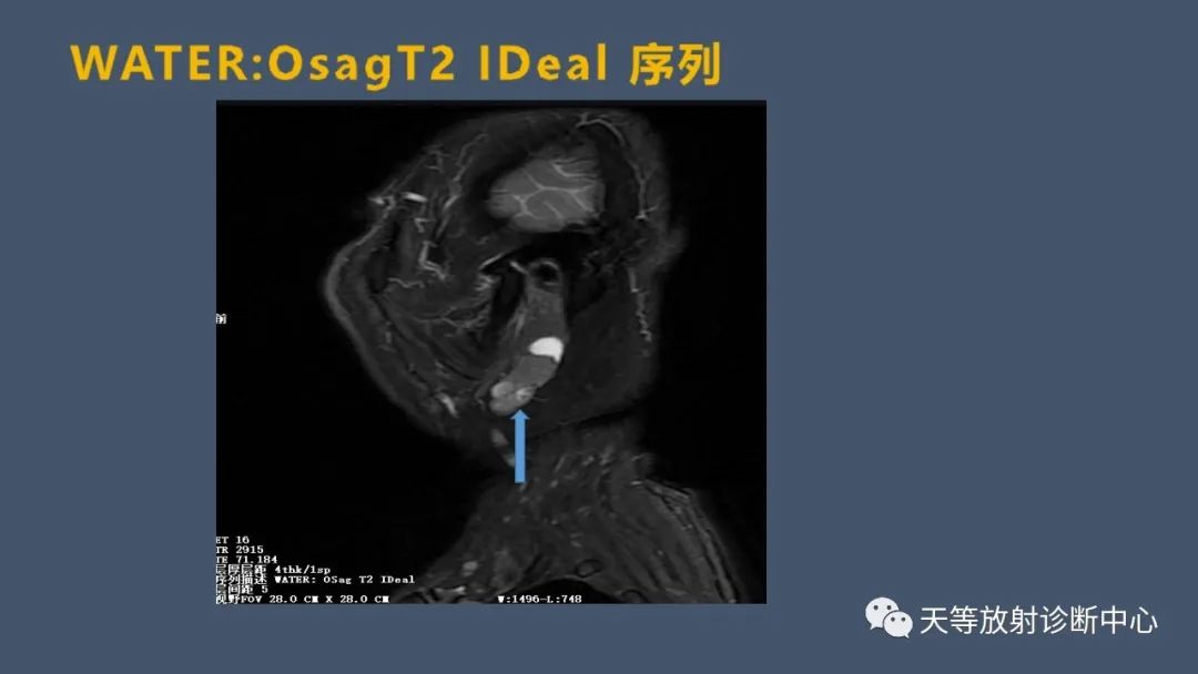 影像PPT - 【病例】腮腺腺淋巴瘤2例CT及MRI表现-6 影像PPT - 【病例】腮腺腺淋巴瘤2例CT及MRI表现-6