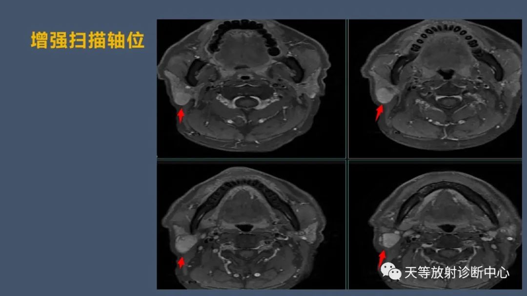 影像PPT - 【病例】腮腺腺淋巴瘤2例CT及MRI表现-7 影像PPT - 【病例】腮腺腺淋巴瘤2例CT及MRI表现-7