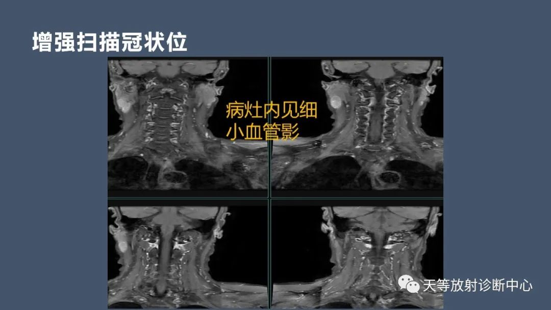 影像PPT - 【病例】腮腺腺淋巴瘤2例CT及MRI表现-8 影像PPT - 【病例】腮腺腺淋巴瘤2例CT及MRI表现-8