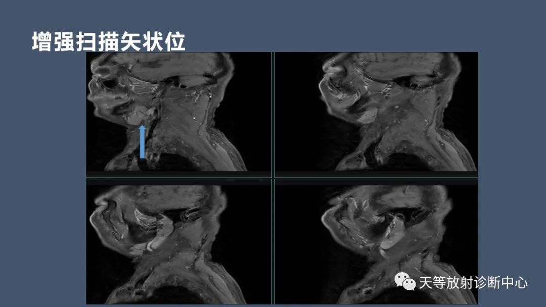 影像PPT - 【病例】腮腺腺淋巴瘤2例CT及MRI表现-9 影像PPT - 【病例】腮腺腺淋巴瘤2例CT及MRI表现-9