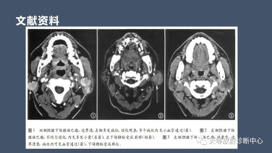 影像PPT - 【病例】腮腺腺淋巴瘤2例CT及MRI表现-11 影像PPT - 【病例】腮腺腺淋巴瘤2例CT及MRI表现-11