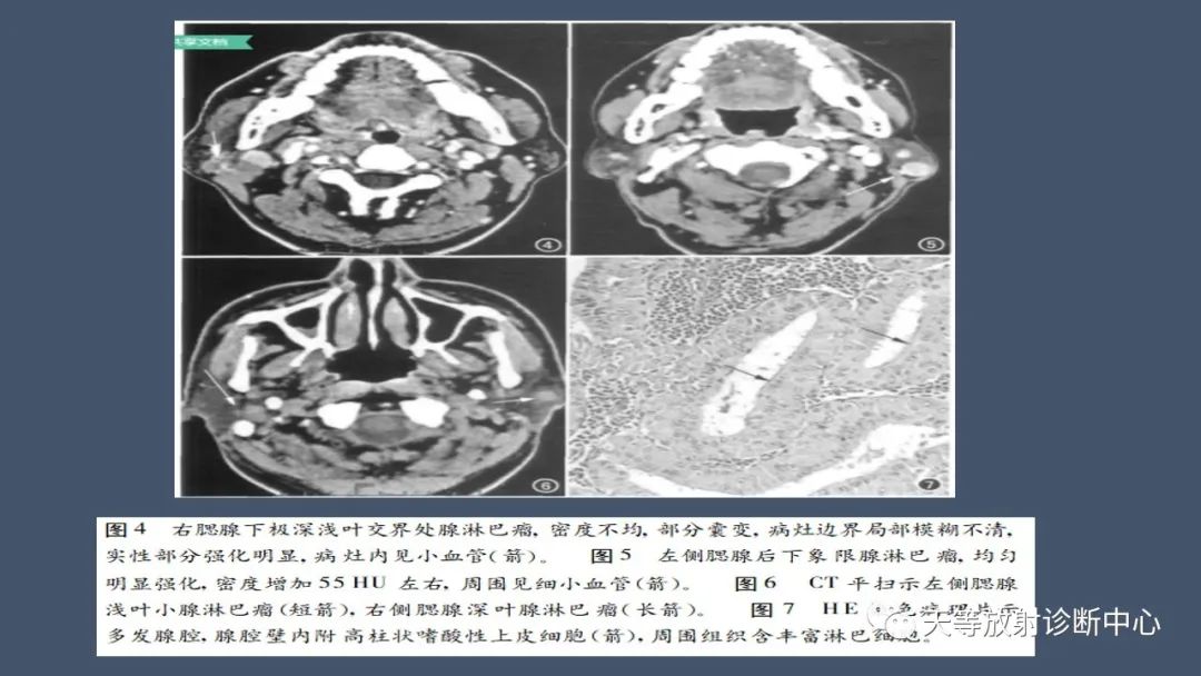 影像PPT - 【病例】腮腺腺淋巴瘤2例CT及MRI表现-12 影像PPT - 【病例】腮腺腺淋巴瘤2例CT及MRI表现-12