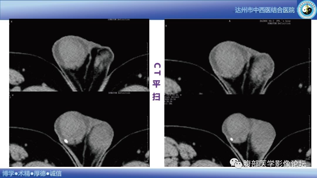 影像PPT - 【病例】睾丸淋巴瘤1例CT及MR影像-4 影像PPT - 【病例】睾丸淋巴瘤1例CT及MR影像-4