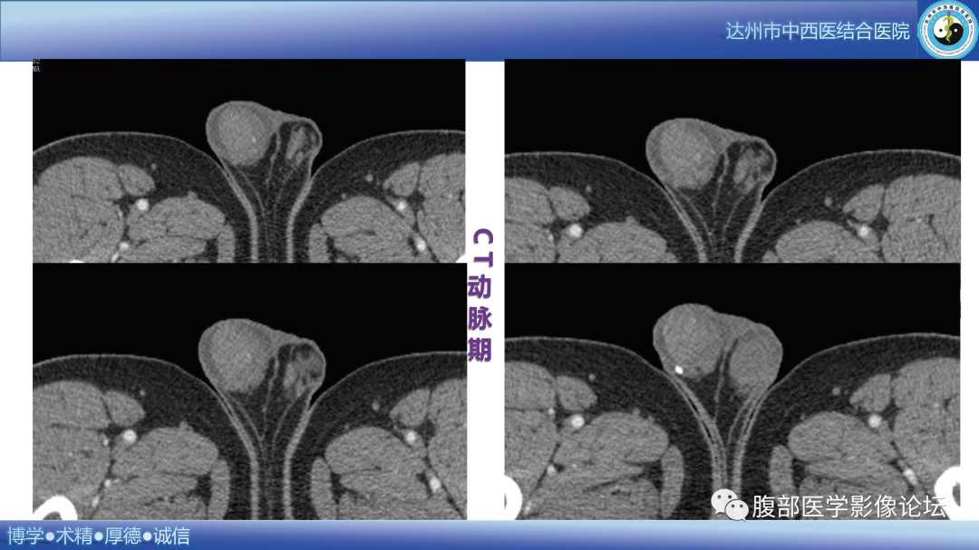 影像PPT - 【病例】睾丸淋巴瘤1例CT及MR影像-5 影像PPT - 【病例】睾丸淋巴瘤1例CT及MR影像-5