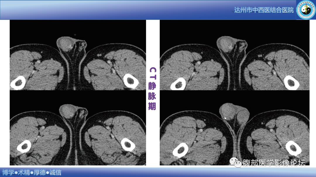 影像PPT - 【病例】睾丸淋巴瘤1例CT及MR影像-6 影像PPT - 【病例】睾丸淋巴瘤1例CT及MR影像-6