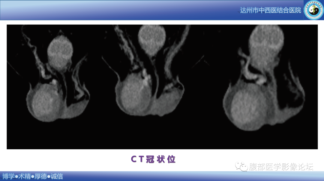 影像PPT - 【病例】睾丸淋巴瘤1例CT及MR影像-7 影像PPT - 【病例】睾丸淋巴瘤1例CT及MR影像-7