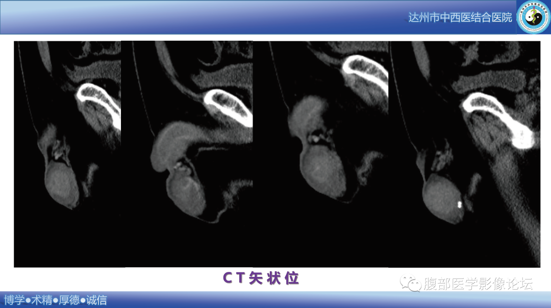 影像PPT - 【病例】睾丸淋巴瘤1例CT及MR影像-8 影像PPT - 【病例】睾丸淋巴瘤1例CT及MR影像-8