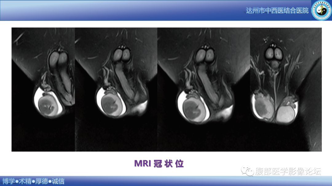影像PPT - 【病例】睾丸淋巴瘤1例CT及MR影像-12 影像PPT - 【病例】睾丸淋巴瘤1例CT及MR影像-12