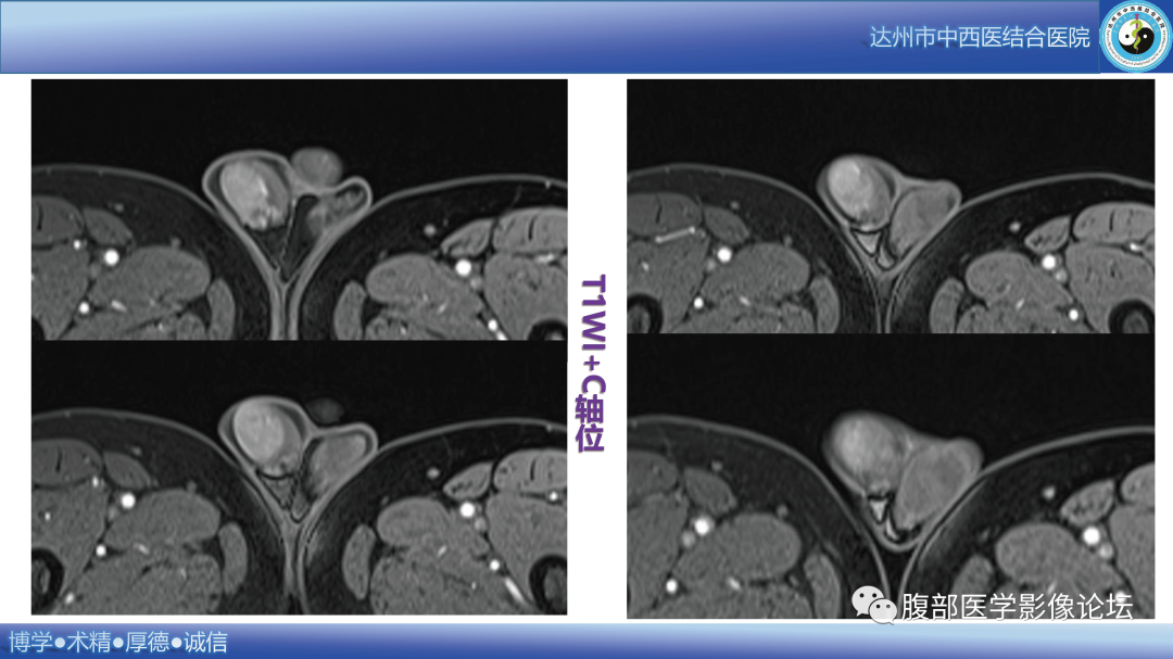影像PPT - 【病例】睾丸淋巴瘤1例CT及MR影像-14 影像PPT - 【病例】睾丸淋巴瘤1例CT及MR影像-14