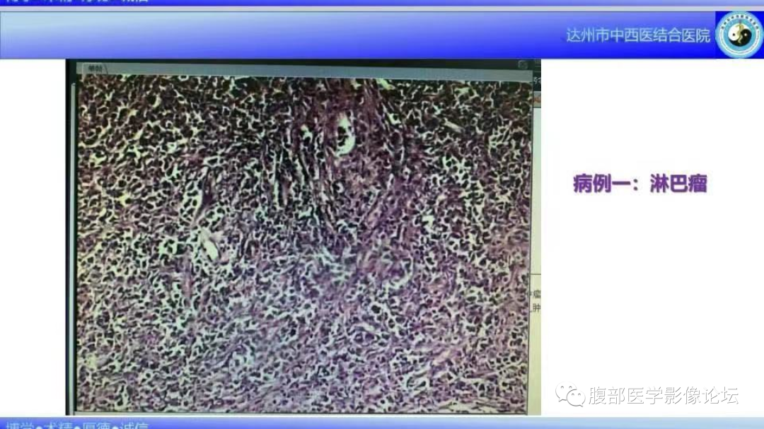 影像PPT - 【病例】睾丸淋巴瘤1例CT及MR影像-16 影像PPT - 【病例】睾丸淋巴瘤1例CT及MR影像-16