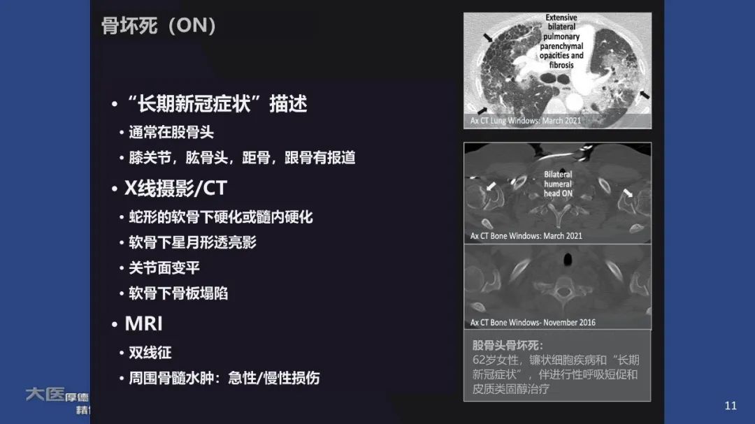 影像PPT - 【PPT】COVID-19 的肌肉骨骼表现：对目前所描述的多模态成像及临床症状的图片综述​-11