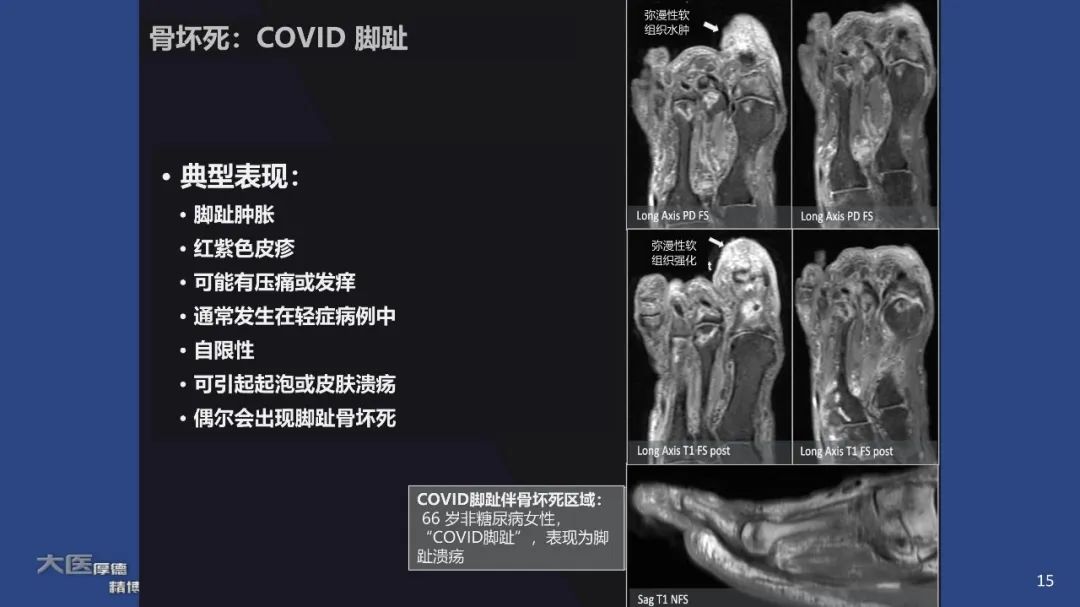 影像PPT - 【PPT】COVID-19 的肌肉骨骼表现：对目前所描述的多模态成像及临床症状的图片综述​-15