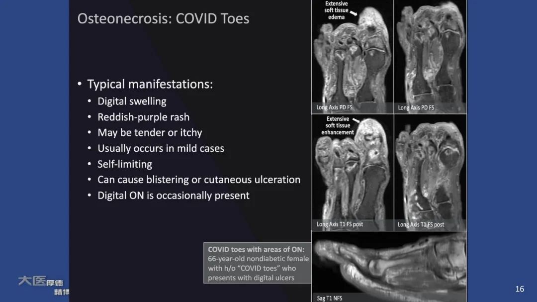 影像PPT - 【PPT】COVID-19 的肌肉骨骼表现：对目前所描述的多模态成像及临床症状的图片综述​-16