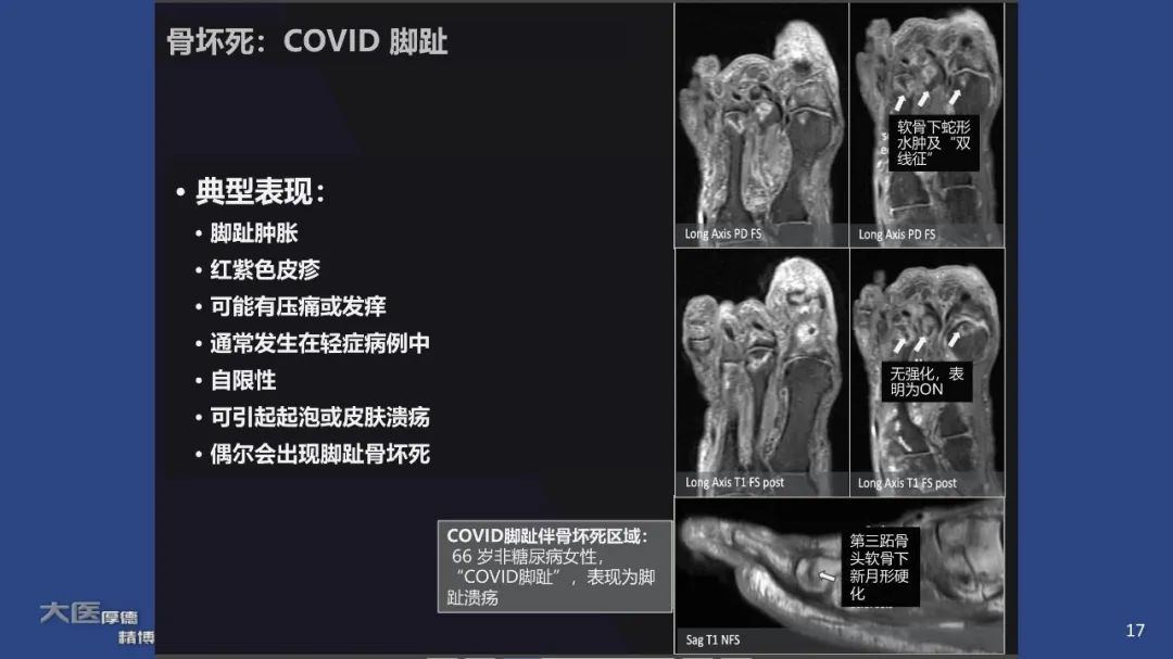 影像PPT - 【PPT】COVID-19 的肌肉骨骼表现：对目前所描述的多模态成像及临床症状的图片综述​-17