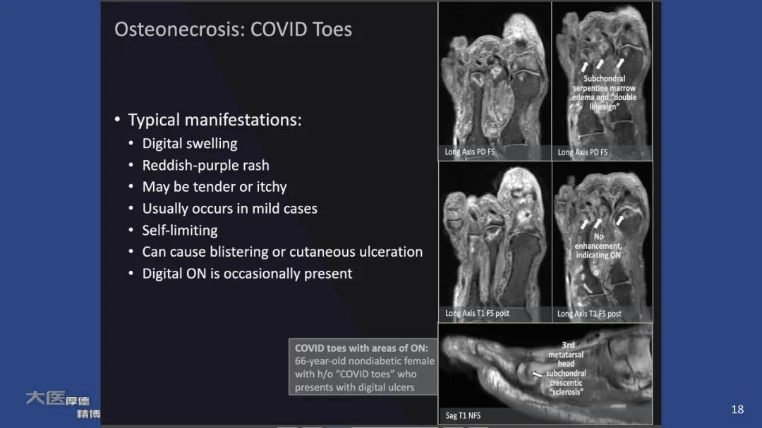 影像PPT - 【PPT】COVID-19 的肌肉骨骼表现：对目前所描述的多模态成像及临床症状的图片综述​-18