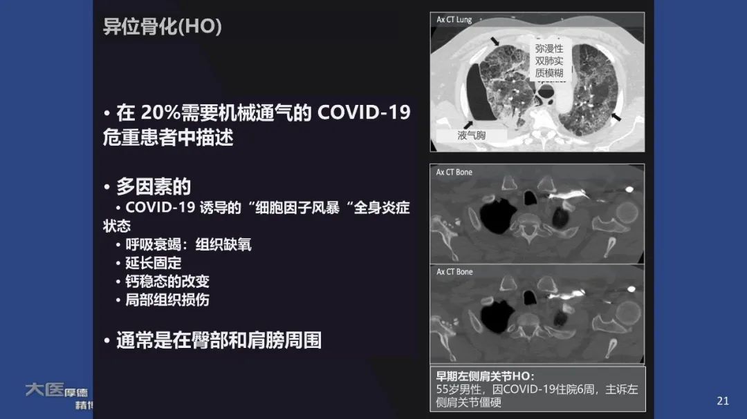 影像PPT - 【PPT】COVID-19 的肌肉骨骼表现：对目前所描述的多模态成像及临床症状的图片综述​-21