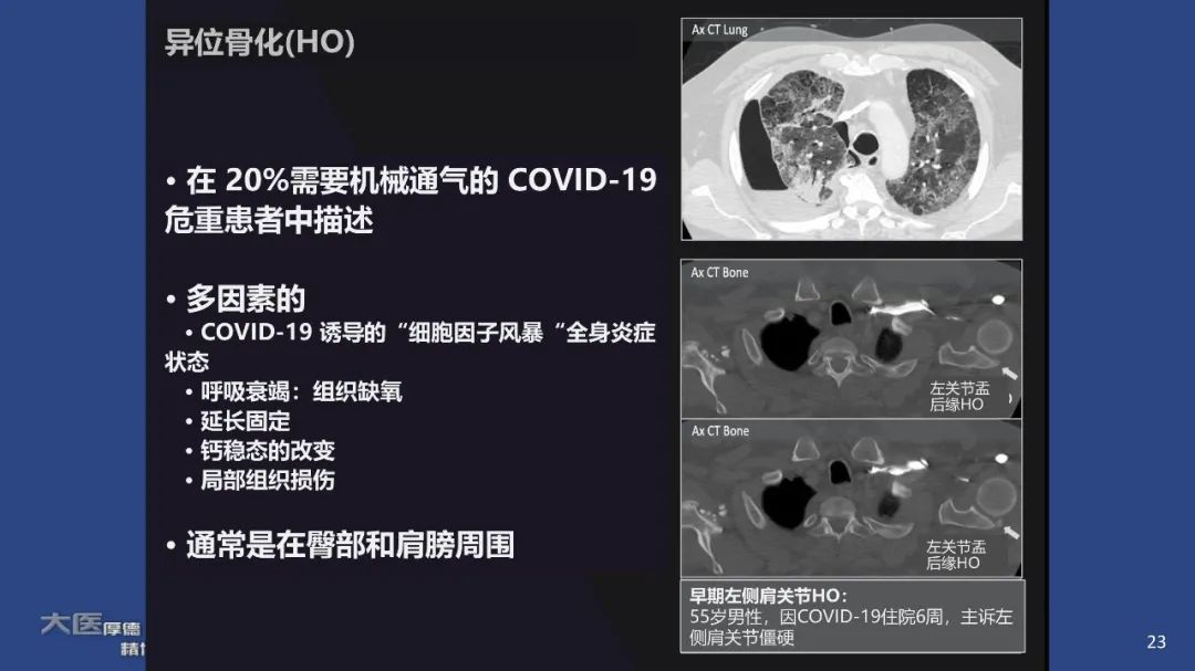 影像PPT - 【PPT】COVID-19 的肌肉骨骼表现：对目前所描述的多模态成像及临床症状的图片综述​-23