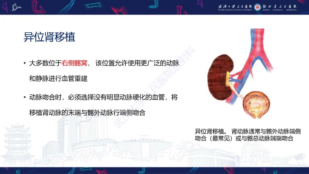 影像PPT - 【PPT】肾移植受者术前CT评估-5
