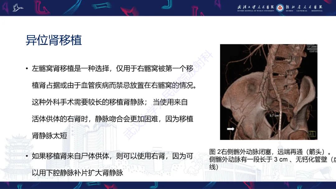 影像PPT - 【PPT】肾移植受者术前CT评估-6