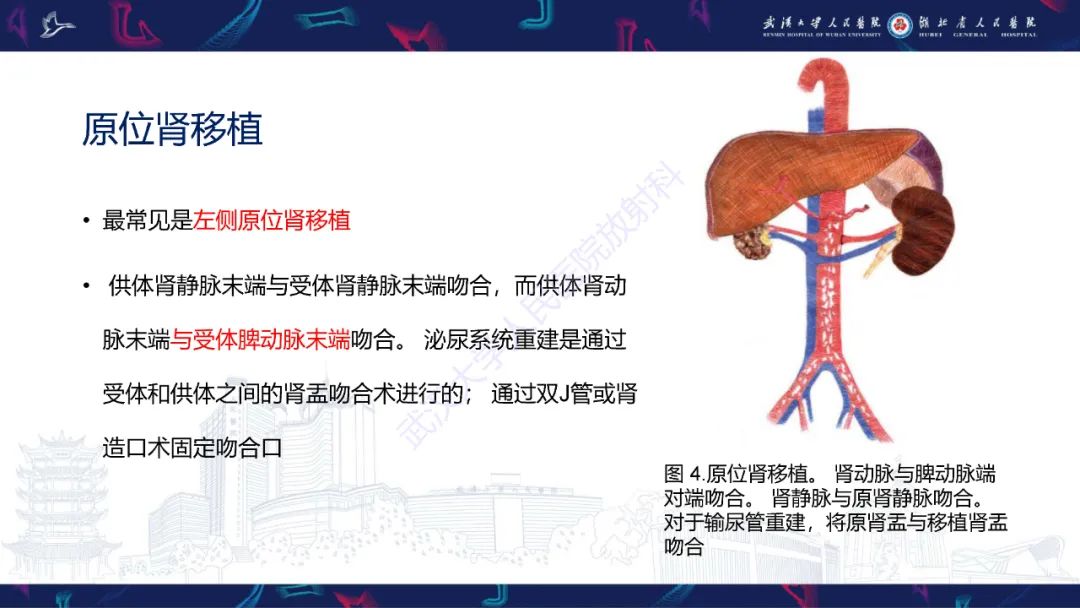 影像PPT - 【PPT】肾移植受者术前CT评估-8