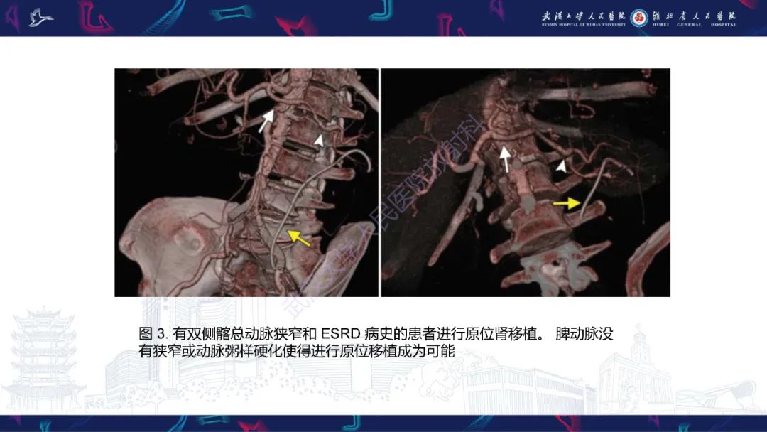 影像PPT - 【PPT】肾移植受者术前CT评估-9