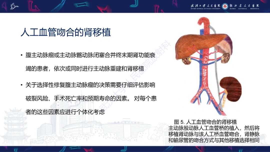 影像PPT - 【PPT】肾移植受者术前CT评估-10