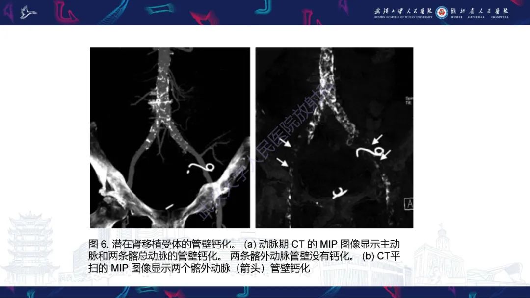 影像PPT - 【PPT】肾移植受者术前CT评估-11