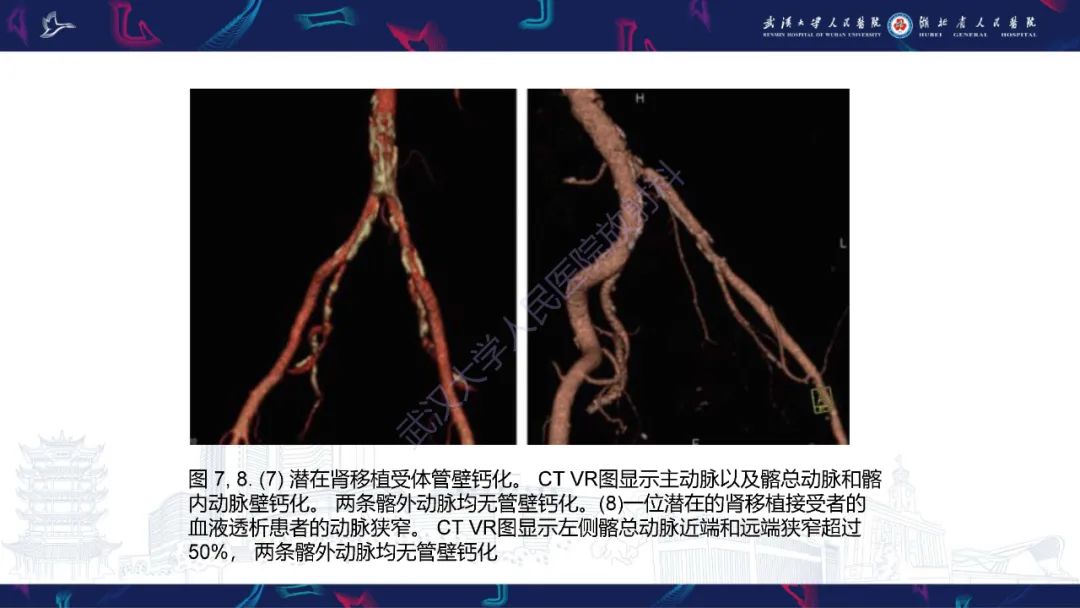 影像PPT - 【PPT】肾移植受者术前CT评估-12