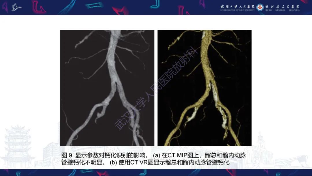 影像PPT - 【PPT】肾移植受者术前CT评估-14