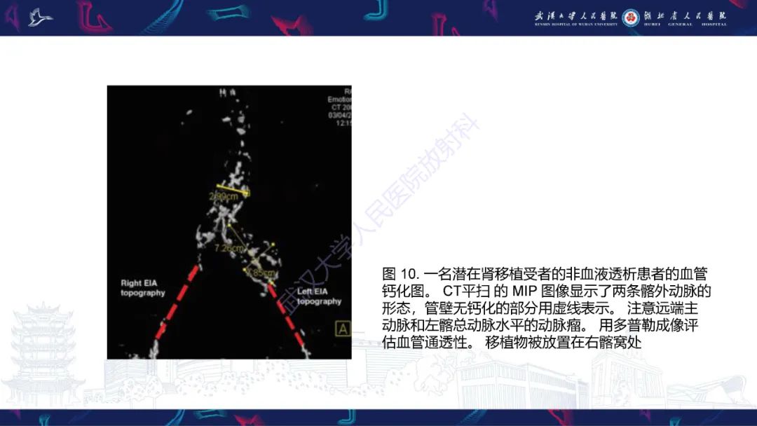 影像PPT - 【PPT】肾移植受者术前CT评估-15