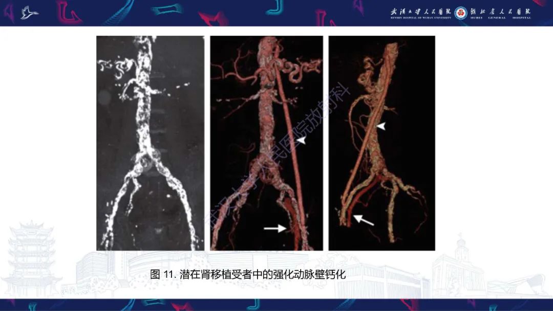 影像PPT - 【PPT】肾移植受者术前CT评估-16