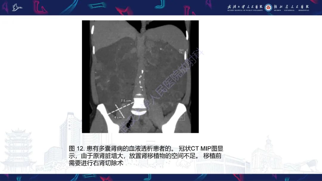 影像PPT - 【PPT】肾移植受者术前CT评估-17