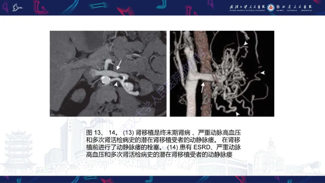 影像PPT - 【PPT】肾移植受者术前CT评估-19