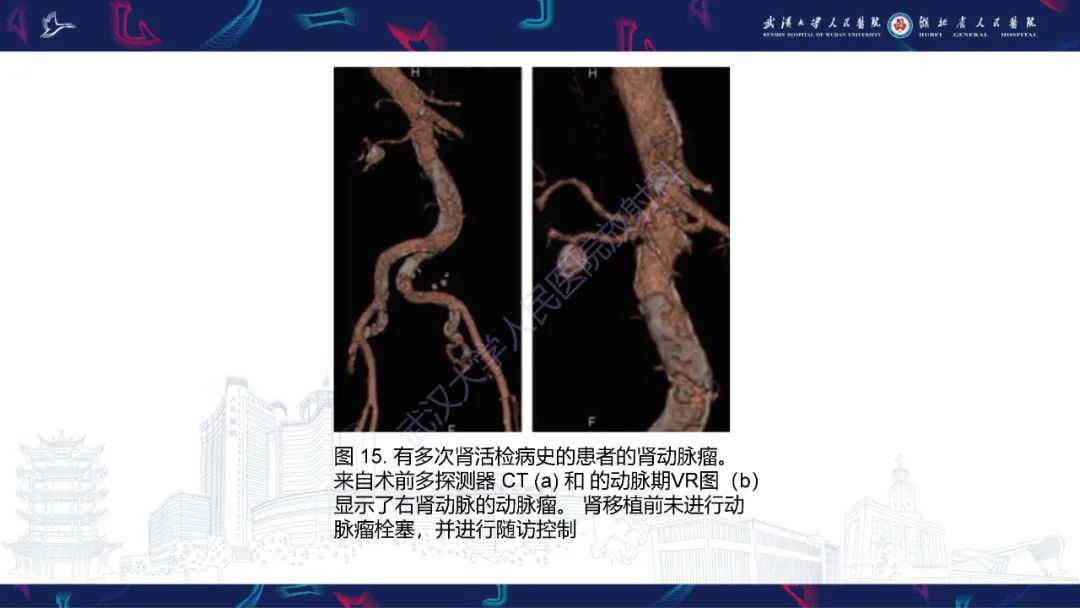 影像PPT - 【PPT】肾移植受者术前CT评估-20