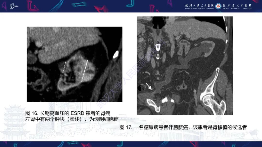 影像PPT - 【PPT】肾移植受者术前CT评估-23