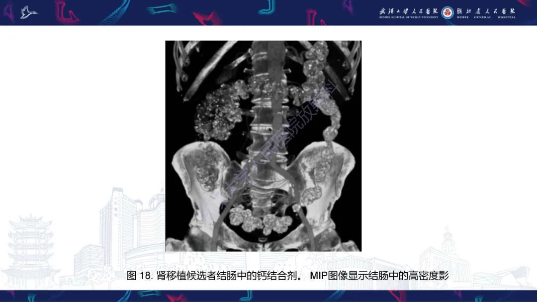 影像PPT - 【PPT】肾移植受者术前CT评估-25