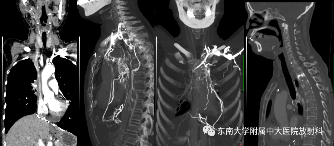 影像PPT - 【PPT】上腔静脉综合征MDCT表现-1 影像PPT - 【PPT】上腔静脉综合征MDCT表现-1
