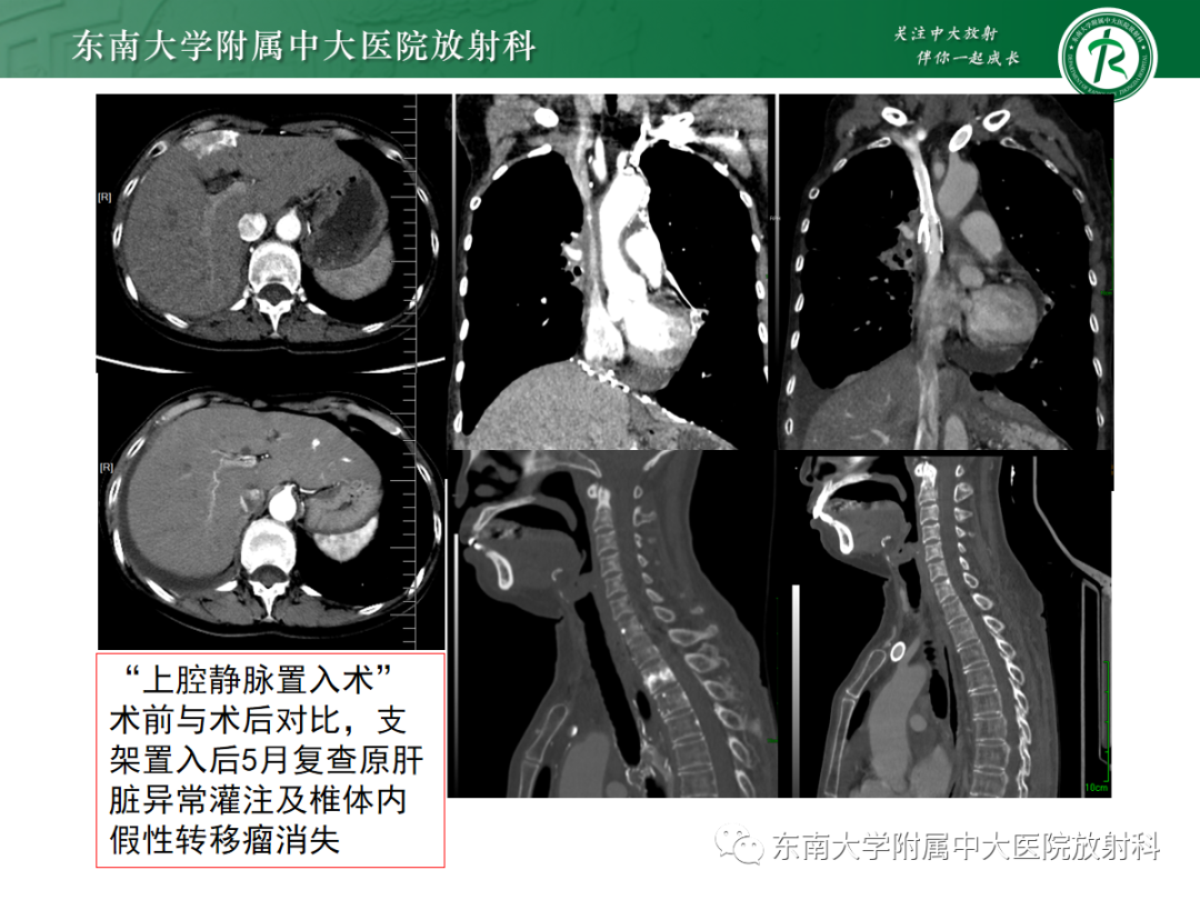 影像PPT - 【PPT】上腔静脉综合征MDCT表现-5 影像PPT - 【PPT】上腔静脉综合征MDCT表现-5